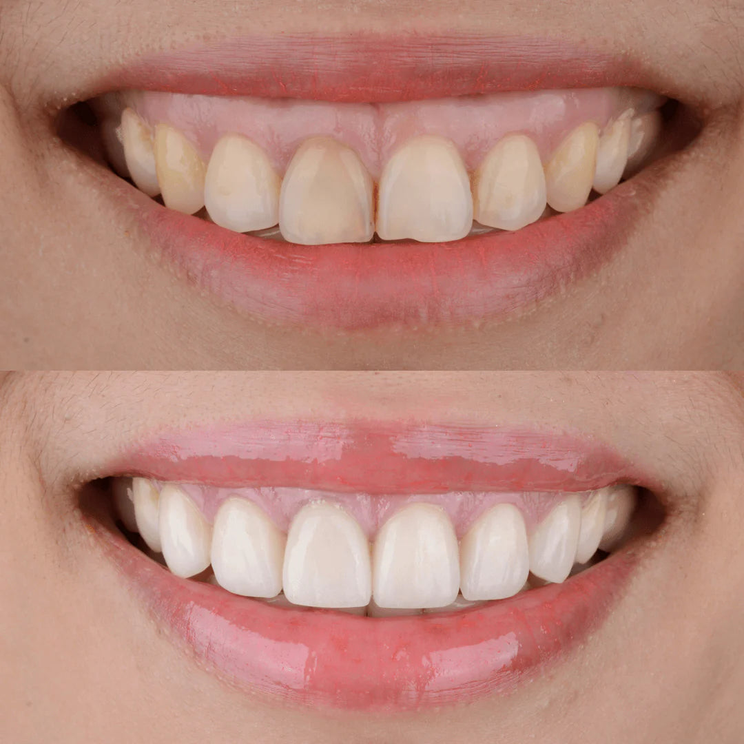 Summer Prep Whitening Bundle