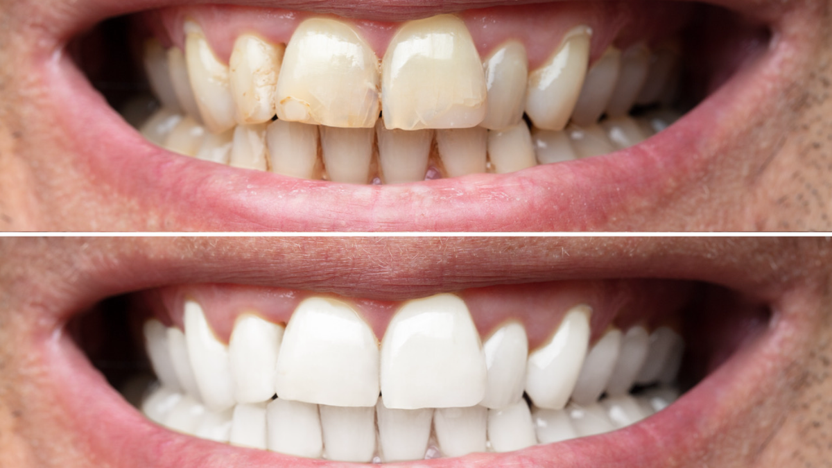 Real customer teeth before and after Smirk PAP Pro