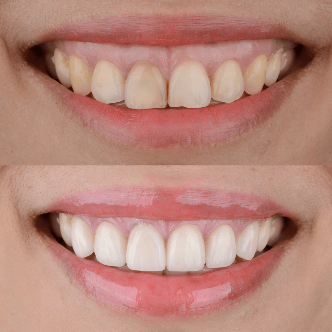 Poudre de blanchiment des dents PAP | Approuvé par le dentiste