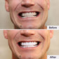 Teeth Whitening Kit | PAP Pro