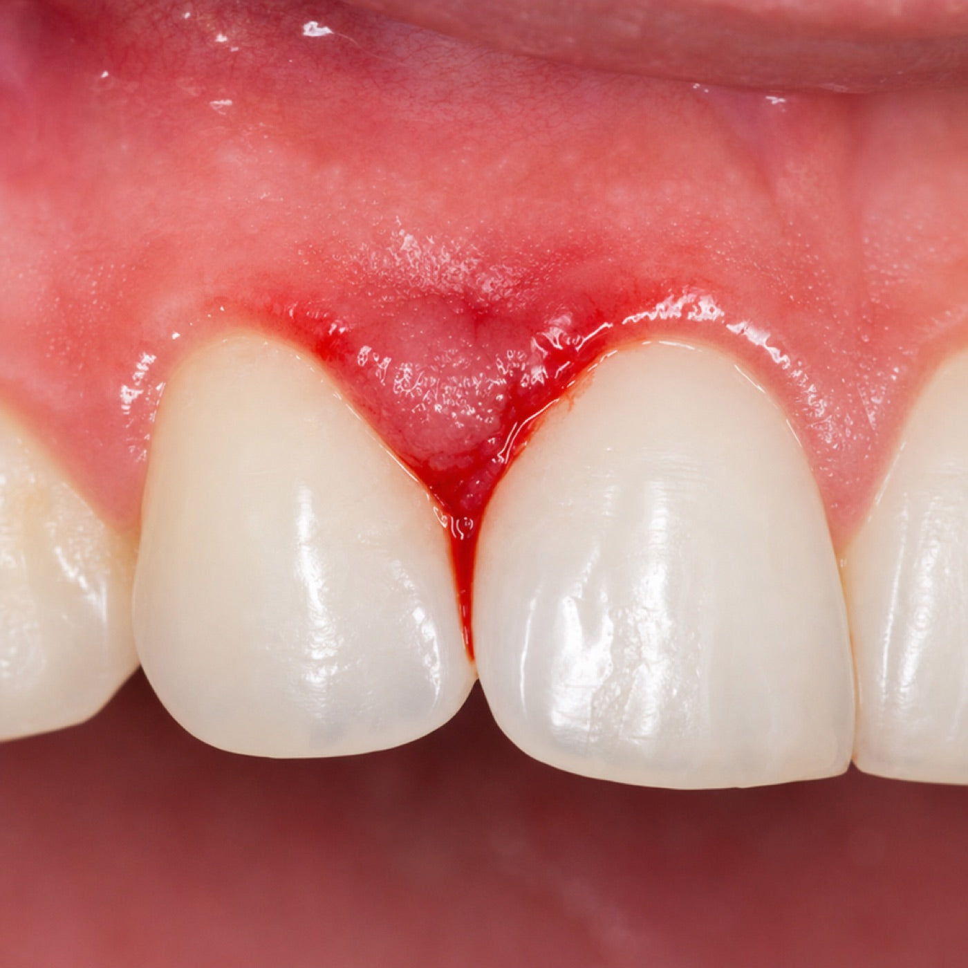 Bleeding gums between two front teeth