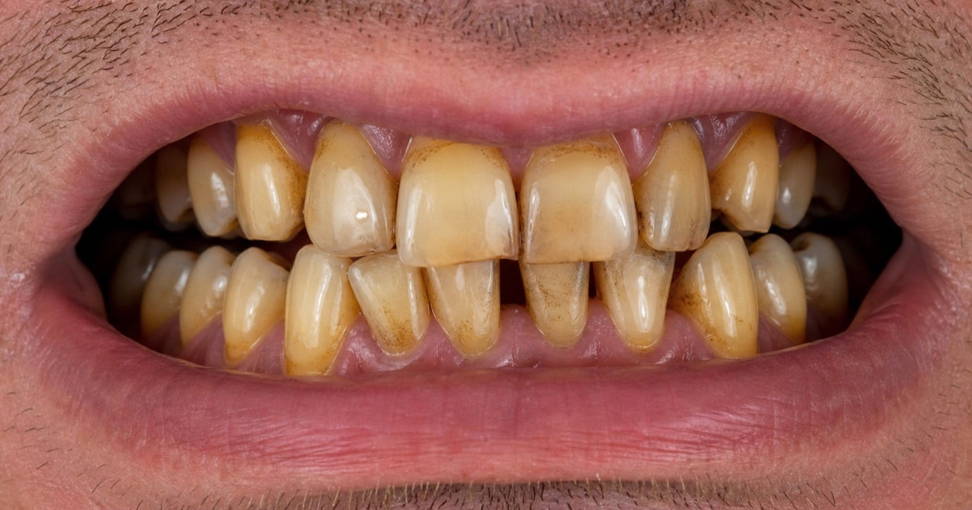 Close-up of yellowed, stained teeth