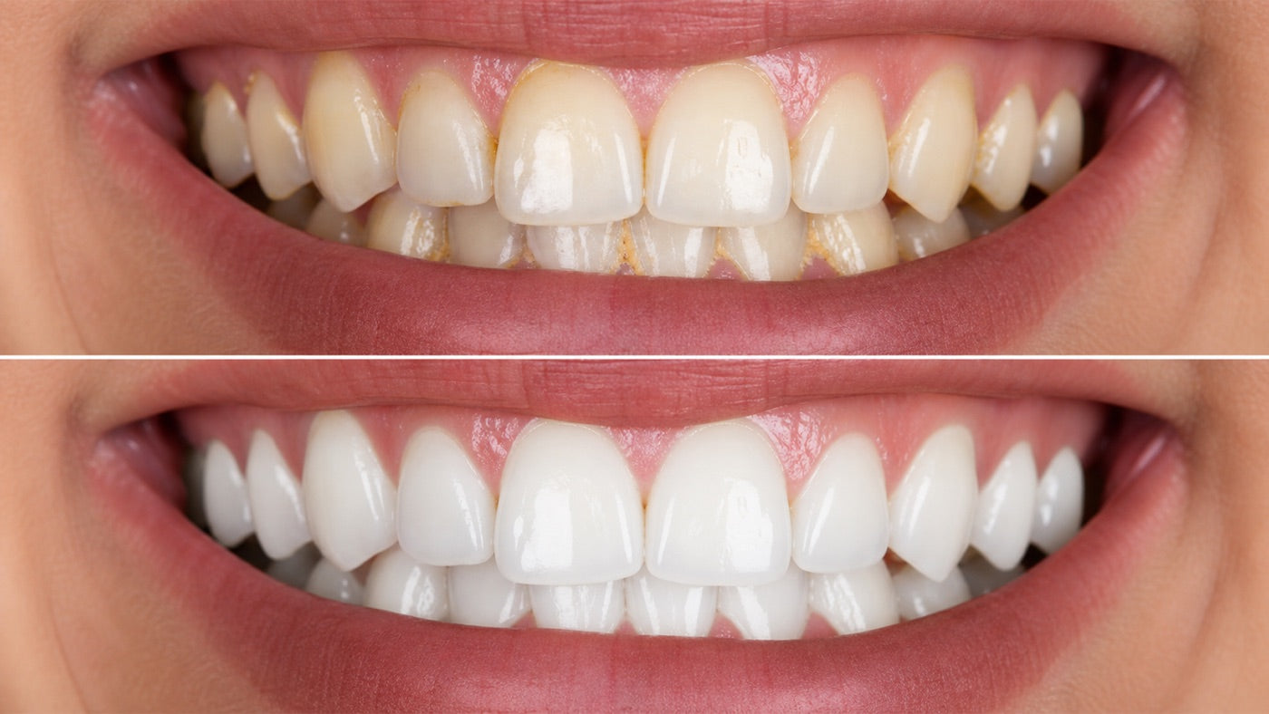 Before and after: yellowed teeth versus a bright white smile