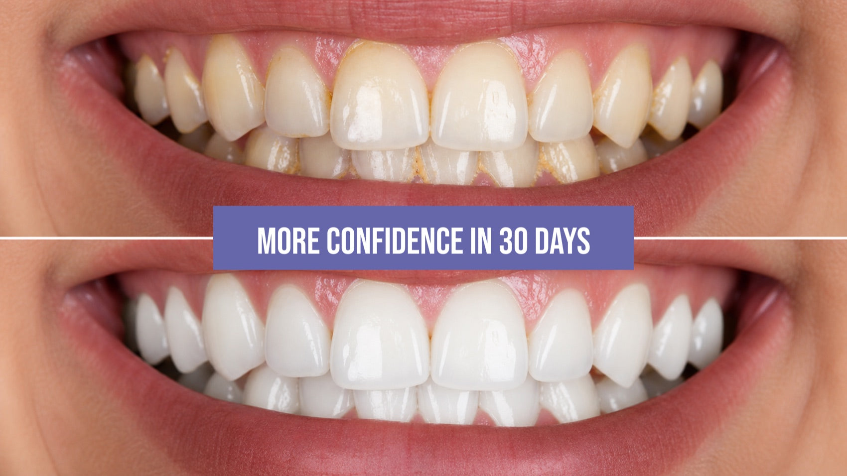 Whiter teeth — more confidence in 30 days