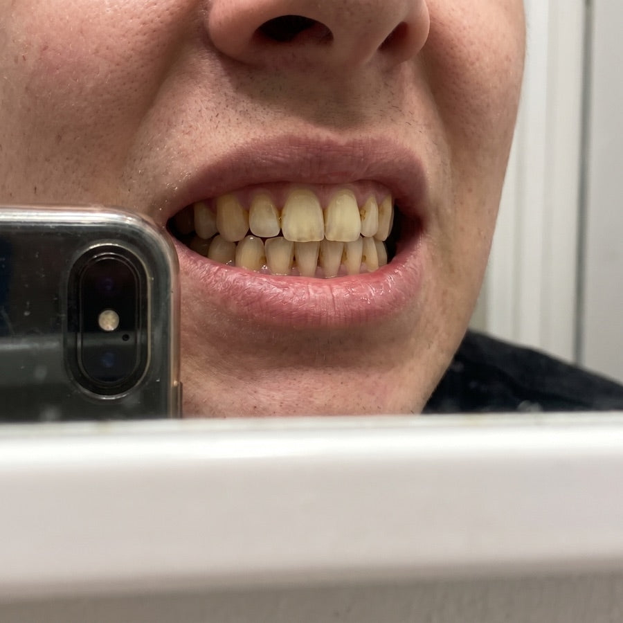 Real photo of yellowed teeth