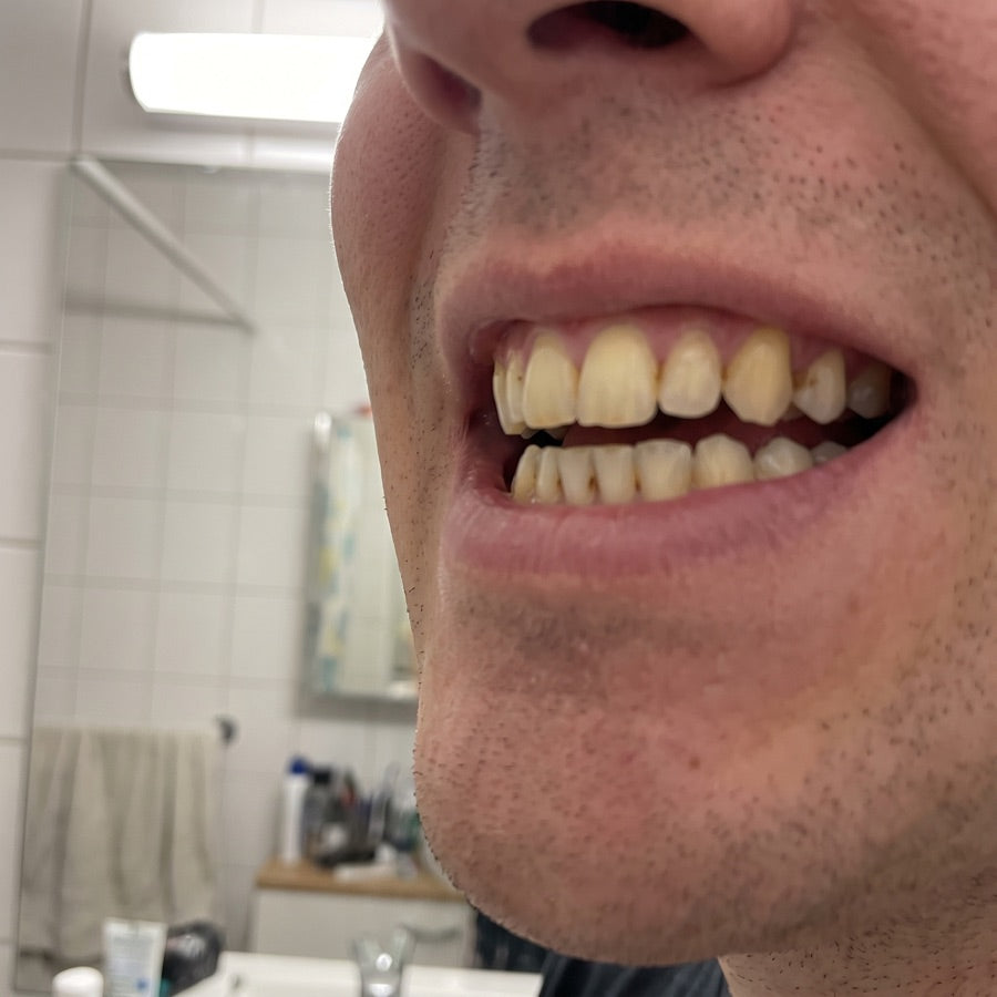 Real photo of yellowed teeth